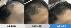 治療3ヶ月