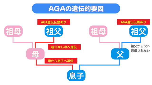 20代 AGA 原因 遺伝