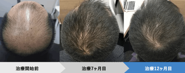 AGAヘアクリニック症例写真