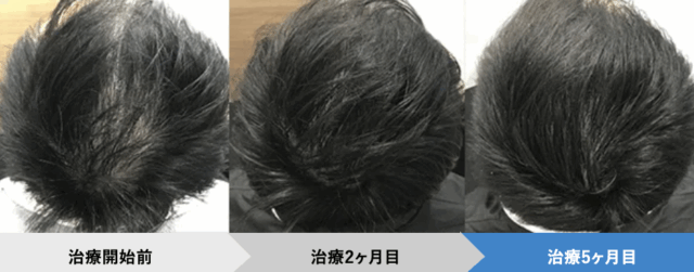 AGAヘアクリニック症例写真