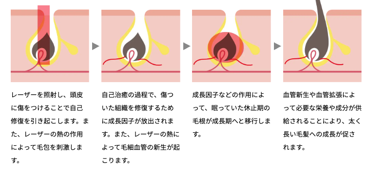Folixレーザーの効果