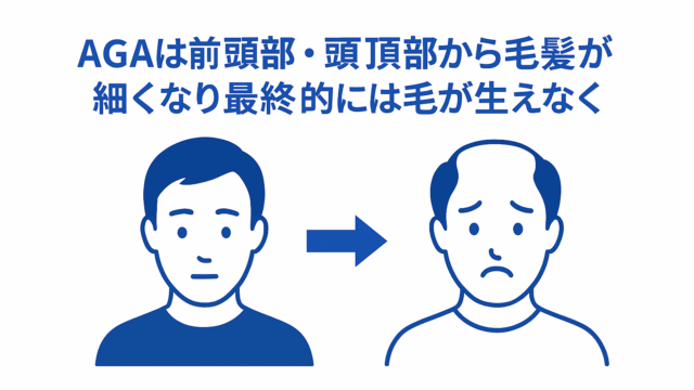 AGAは前頭部・頭頂部から毛髪が細くなり最終的には毛が生えなくなる