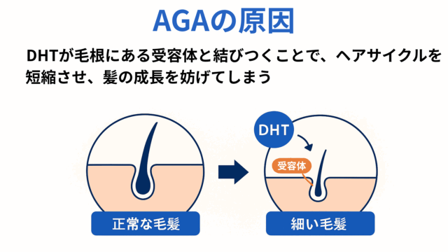 aga 発症したら終わり「AGAの原因」