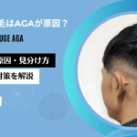 AGA　側頭部　薄毛