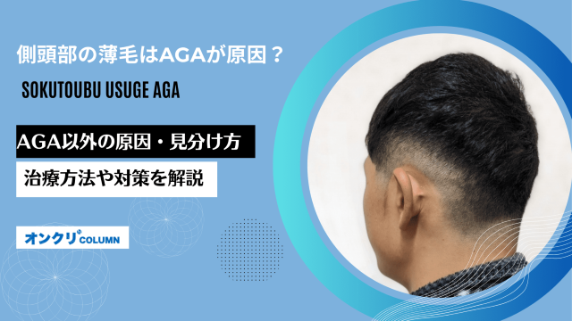 AGA　側頭部　薄毛