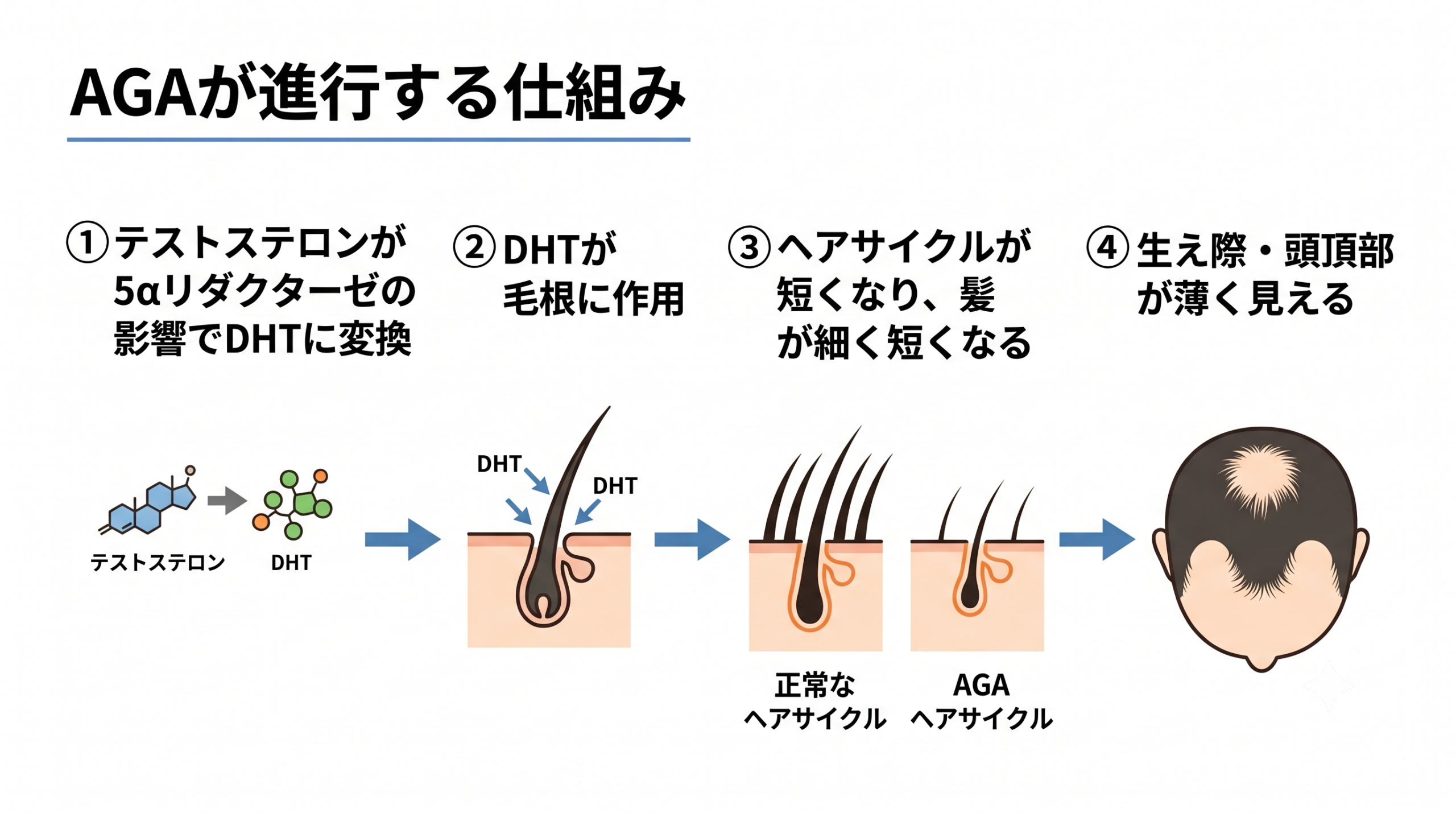 AGAが進行する仕組み