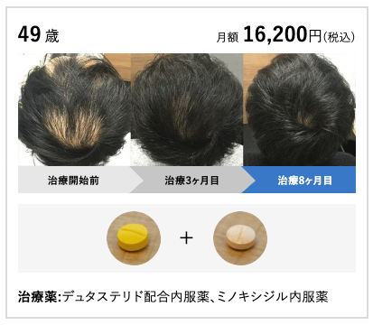 AGAヘアクリニックの治療写真