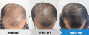 AGAヘアクリニックの症例①