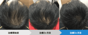 AGAヘアクリニック症例①