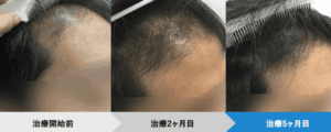 AGAヘアクリニック症例②