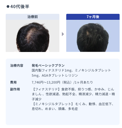 DMMオンラインクリニックの治療写真