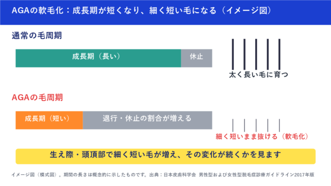 AGAの軟毛化（毛周期のイメージ図）