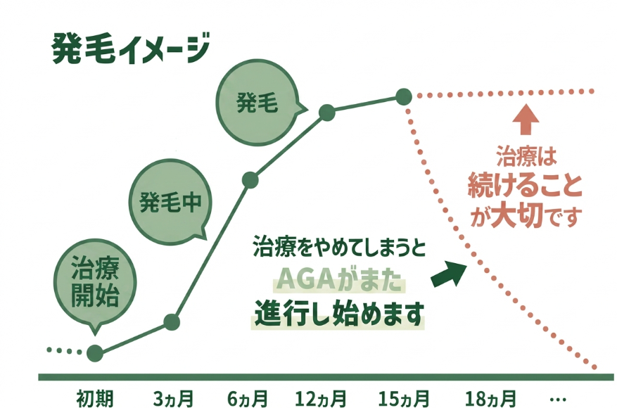 aga,仙台,おすすめ_治療の継続と変化のグラフ（イメージ）