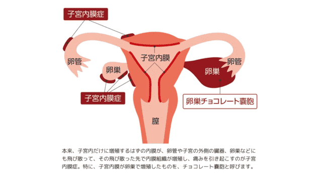 チョコレート嚢胞 がん化