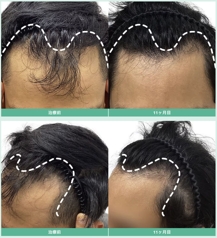 デュタステリド・サプリメント 12ヶ月