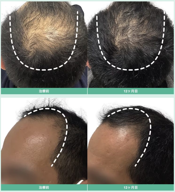 デュタステリド・ミノキシジル 12ヶ月