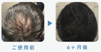 デュタステリド＋ミノキシジル5mg 32歳 6ヶ月