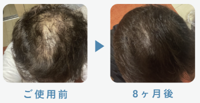 デュタステリド＋ミノキシジル5mg 38歳 8ヶ月