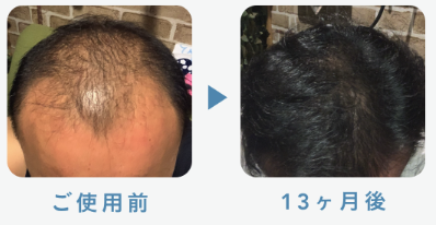 デュタステリド＋ミノキシジル5mg 43歳 13ヶ月