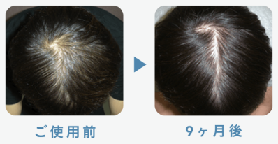 フィナステリド1mg 20歳 9ヶ月