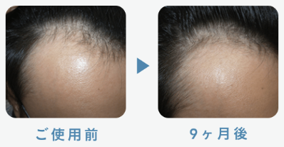 フィナステリド1mg 22歳 9ヶ月