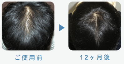 フィナステリド1mg 25歳 12ヶ月