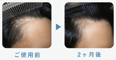 フィナステリド1mg 25歳 2ヶ月