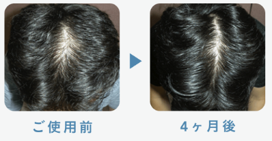 フィナステリド1mg 37歳 4ヶ月