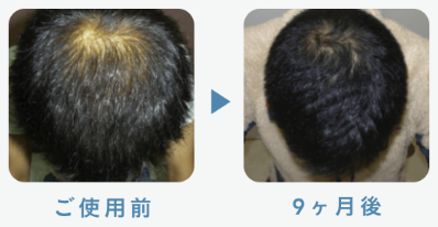 フィナステリド1mg＋ミノキシジル5mg 43歳 9ヶ月