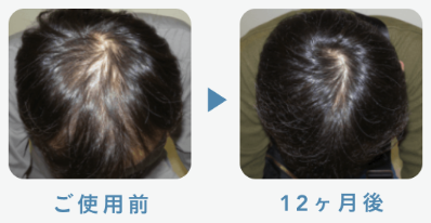 フィナステリド1mg＋ミノキシジル5mg 51歳 12ヶ月