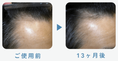 フィナステリド1mg＋ミノキシジル5mg 51歳 13ヶ月