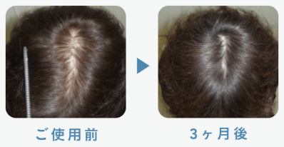 フィナステリド1mg＋ミノキシジル5mg 53歳 3ヶ月