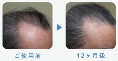フィナステリド1mg＋ミノキシジル5mg. 58歳 12ヶ月