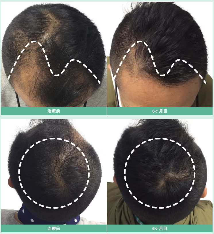 フィナステリド・ミノキシジル 12ヶ月