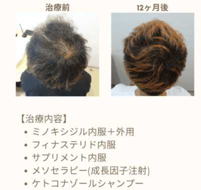 ベアAGAクリニック 症例