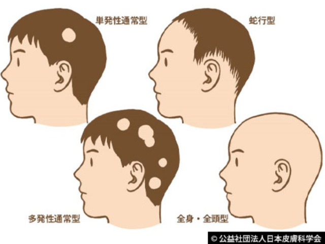 円形脱毛症の特徴