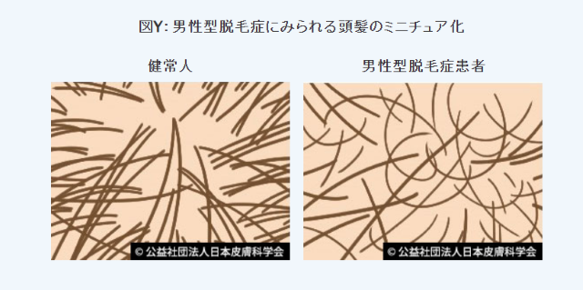 男性型脱毛症にみられる頭髪のミニチュア化
