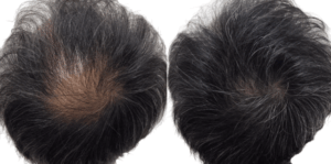 症例・発毛実績①