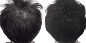 症例・発毛実績②