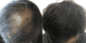 症例・発毛実績③