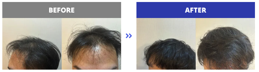 発毛プラン 症例写真