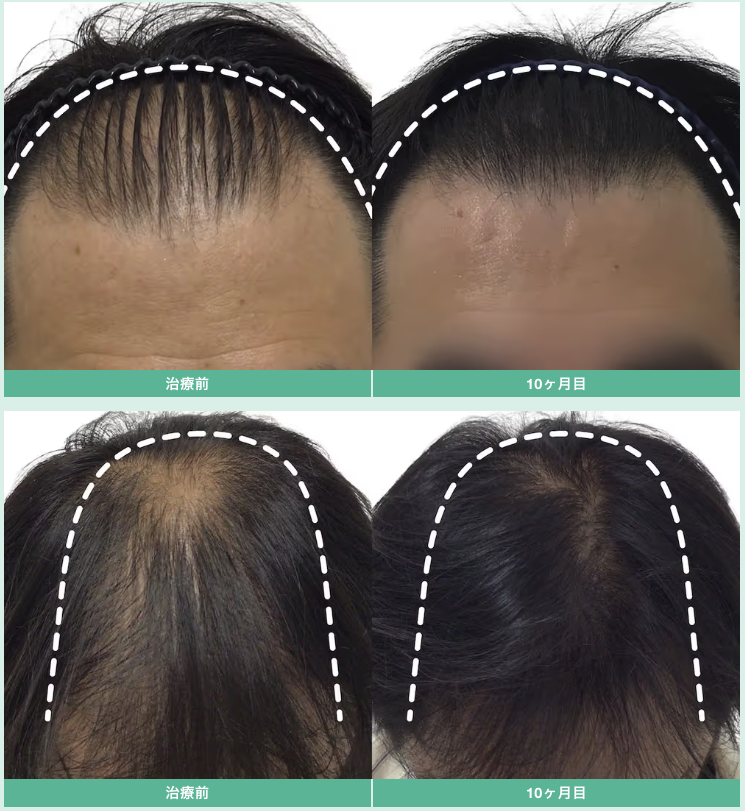 超発毛メソ（12回）・Birth・CPローション 12ヶ月 2