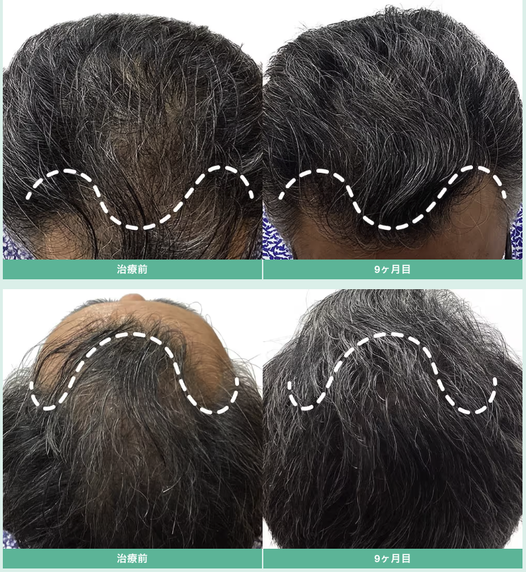 超発毛メソ（12回）・Birth・CPローション 12ヶ月 3