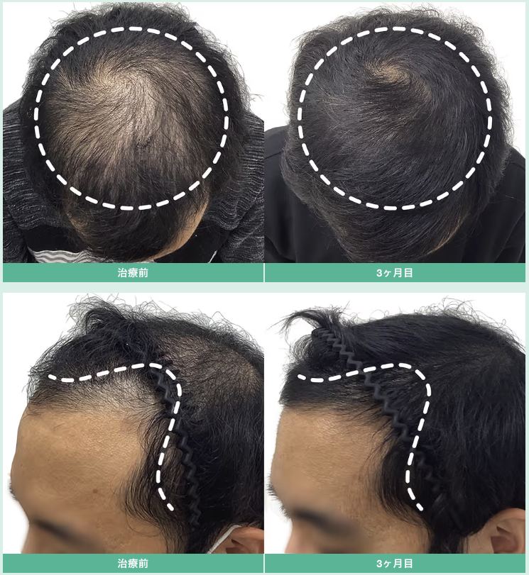 超発毛メソ（12回）・Birth・CPローション 12ヶ月